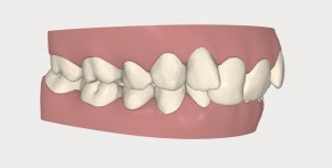 Invisalign