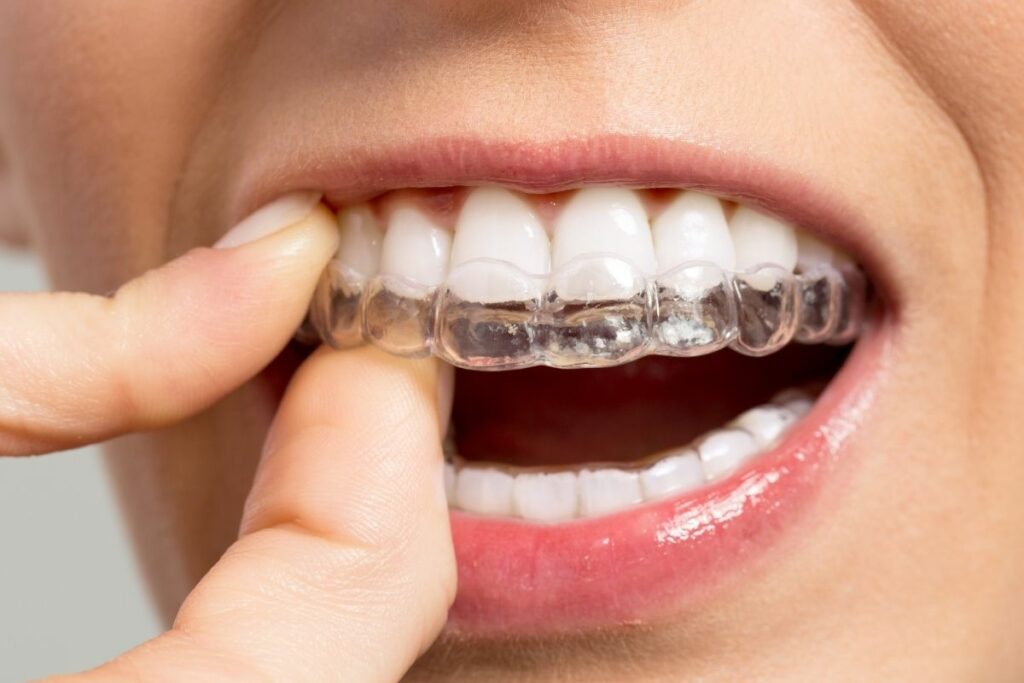 Appareil dentaire invisible Invisalign