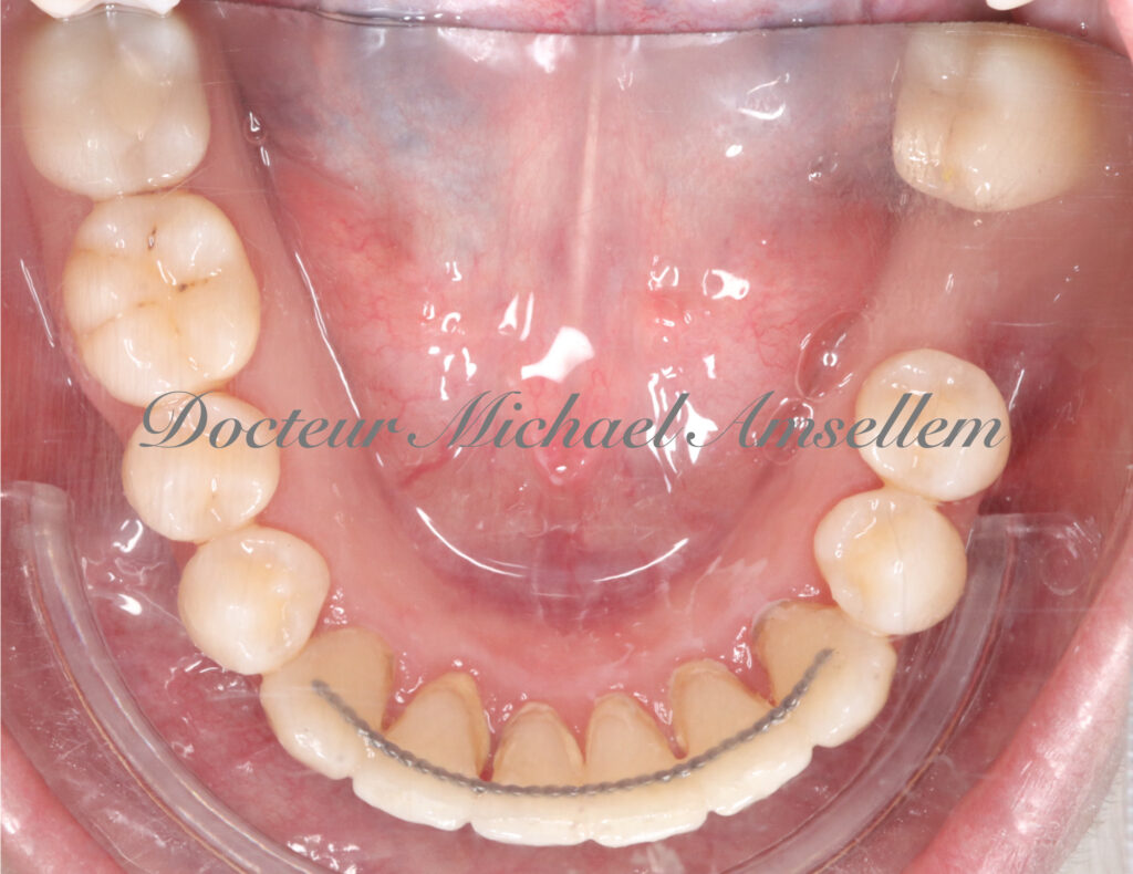 Gestion d'une DDM critique chez une patiente adulte par aligneurs orthodontiques