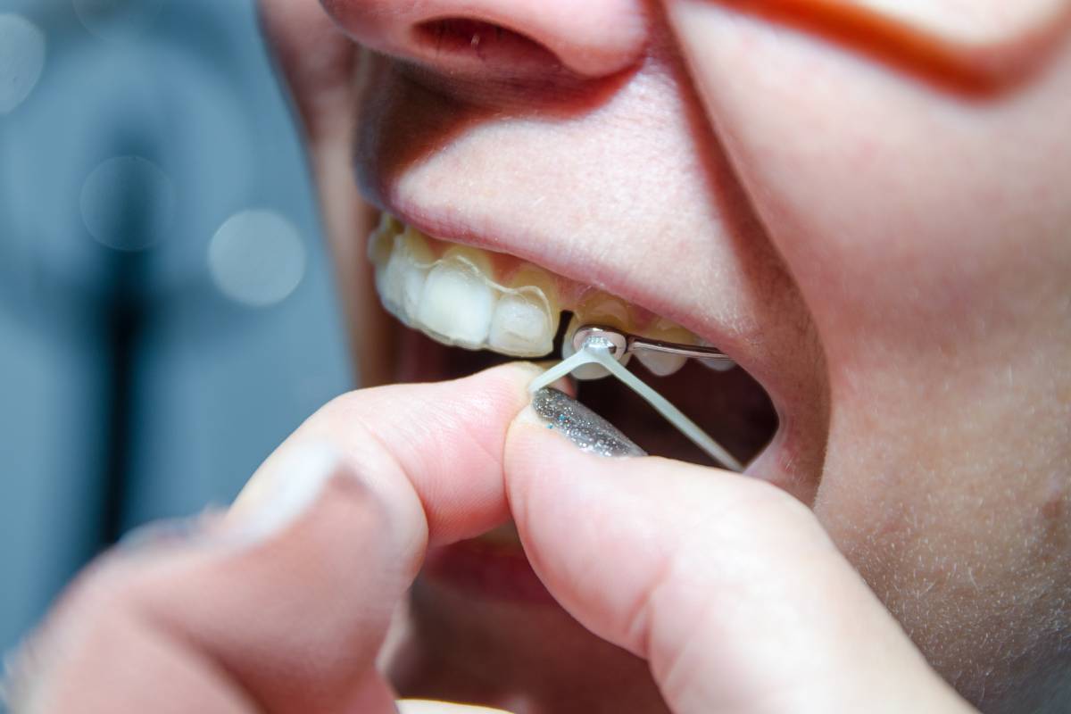 Elastiques orthodontiques