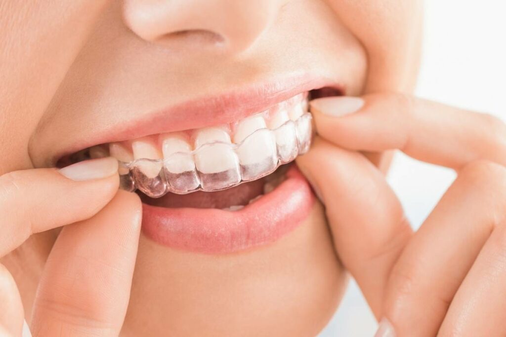 Gouttières transparentes pour aligner les dents discrètement